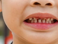 Gigi Berlubang pada Anak, Kenali Bahaya hingga Cara Mengatasinya