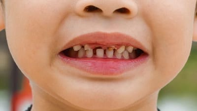 Penyebab Karies Gigi pada Anak dan Cara Merawatnya dengan Tepat